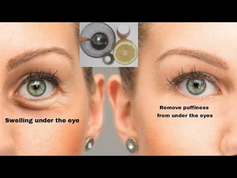 عملية بسيطةللقضاء على الانتفاخ من تحت العيونAn operation to eliminate puffiness from under the eyes