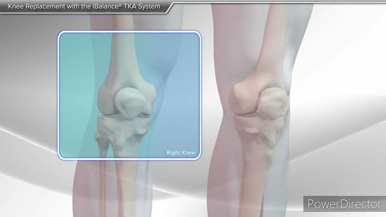 total knee replacement.. gutnay k mukammal elaj