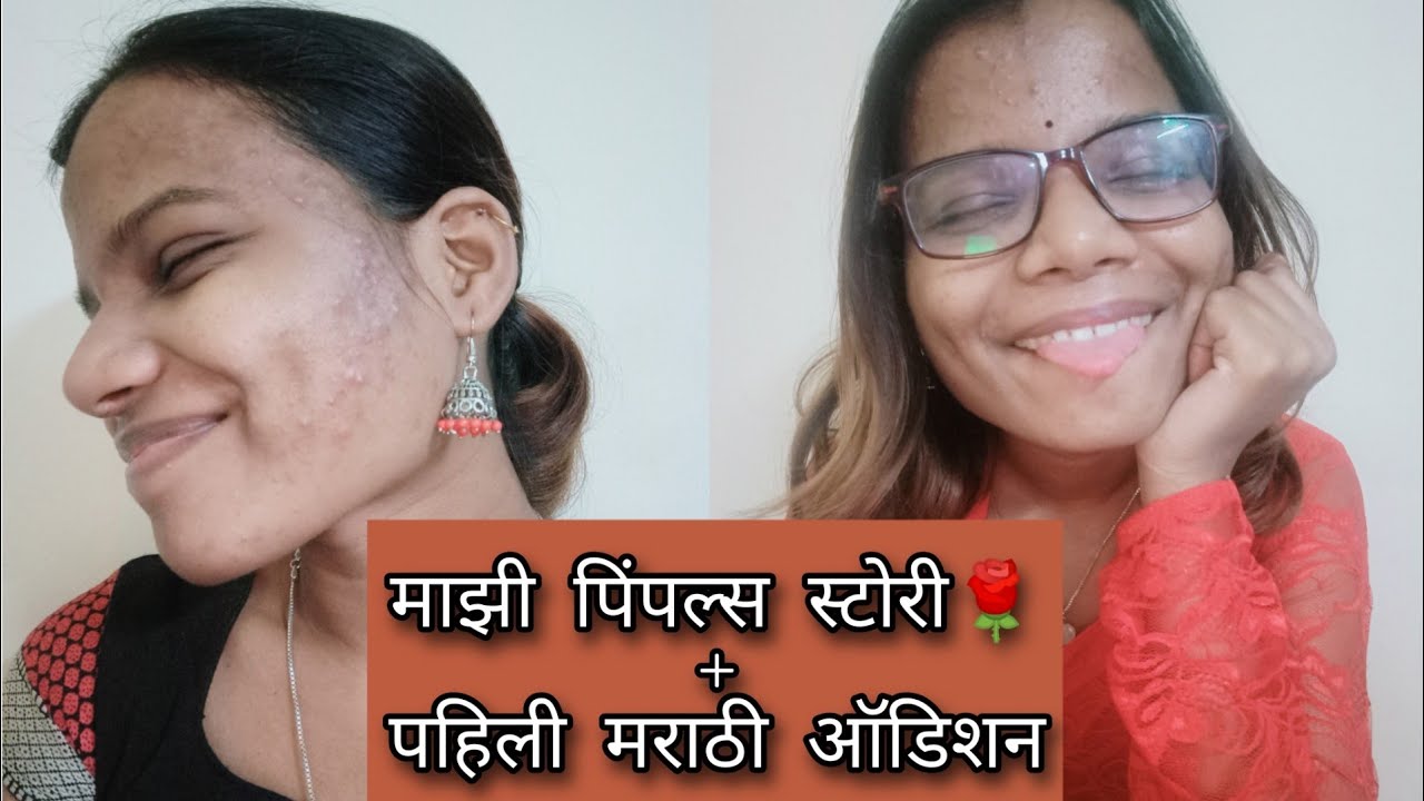 My pimple Story and My First Marathi Audition